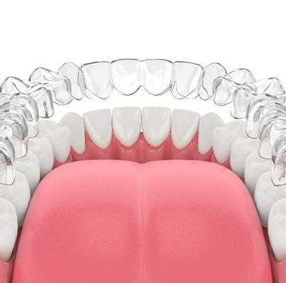 Invisalign aligner being placed on teeth