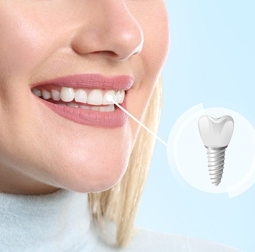  Nose-to-neck view of blond woman smiling with a tooth indicated as an implant