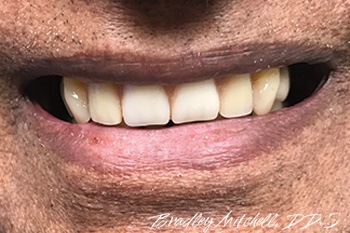 Closeup of flawless smile after dental implants and cosmetic dental crown restoration