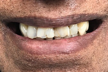 Closeup of damaged smile before dental implants and cosmetic dental crown restoration
