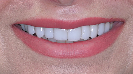 Close up of teeth after treatment
