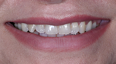 Close up of teeth prior to treatment