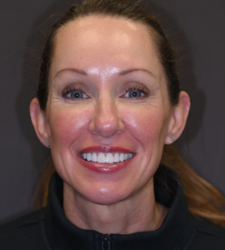 Woman with glasses smiling after tooth has been fixed