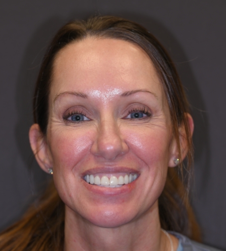 Woman with glasses and chipped tooth