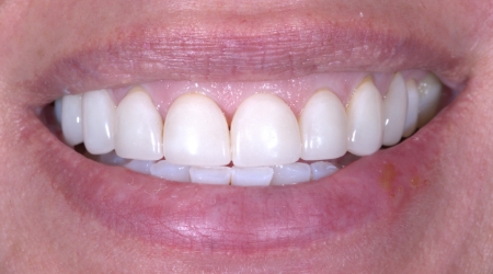 Close-up of smile with worn down and damaged teeth