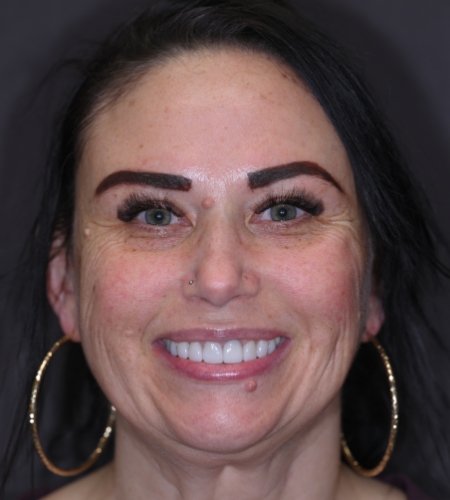 Woman with more properly aligned smile