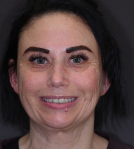 Smiling woman with uneven teeth