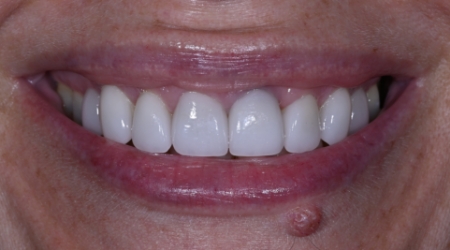 Close-up of smile with more properly sized teeth