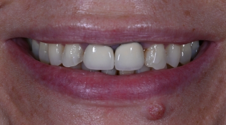 Close-up of smile with small teeth