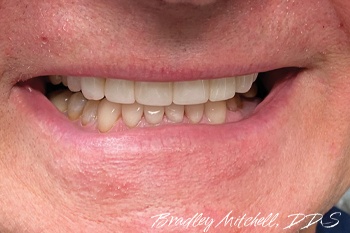 Smile repaired after teeth grinding and clenching damage
