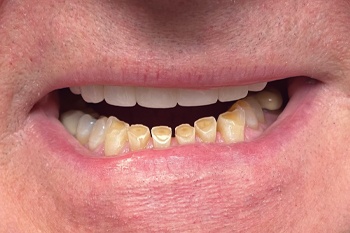 Smile with worn down teeth due to clenching and grinding