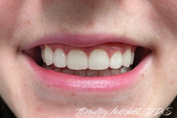 Closeup of bright white smile after veneers