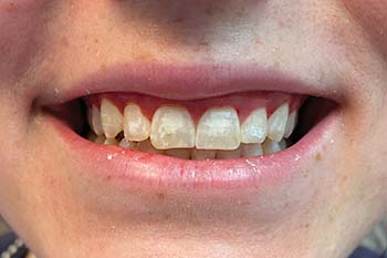 Closeup of smile with white spots before veneers