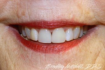 Smile after new dental crown is placed