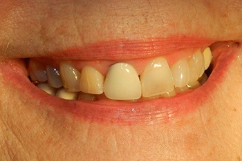 Black line around dental crown