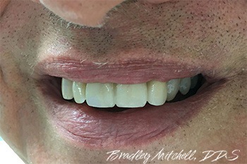 Missing teeth replaced with dental bridge