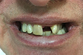 Missing teeth before tooth replacement