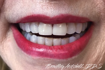 Smile with porcelain dental crown covering fractured tooth