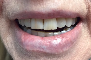 Fractured tooth before dental restoration