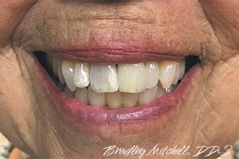 Closeup of smile with dental implants replacing missing teeth