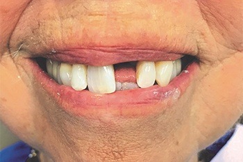 Closeup of smile with missing front teeth