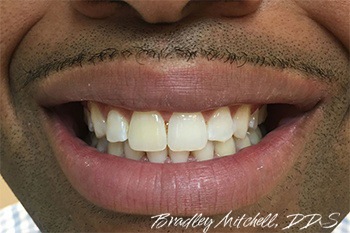 Closeup of flawless smile after Invisalign treatment