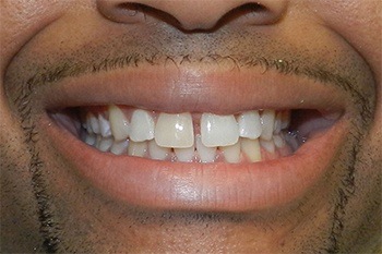 Closeup of flawed smile before Invisalign treatment