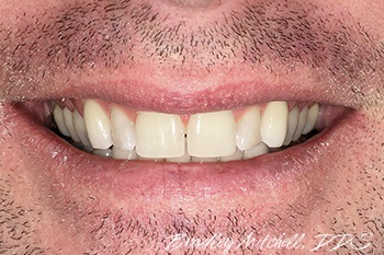 Smile with closed gap after Invisalign treatment