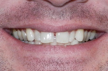 Closeup of smile with gap between teeth