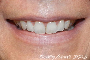 Smile after Invisalign