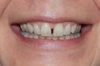 Smile before Invisalign