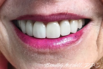 Flawless smile after makeover