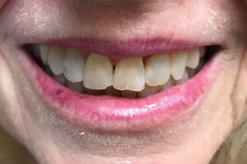 Chipped teeth before smile makeover