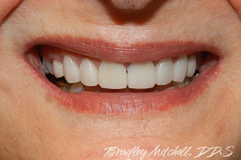 Closeup of smile after veneers