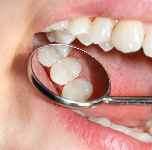 Dentist examining smile after tooth colored filling restoration