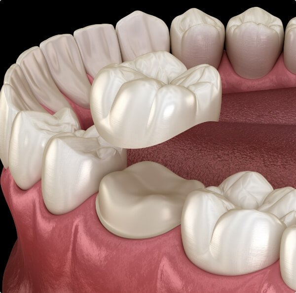 Animated smile during dental crown placement