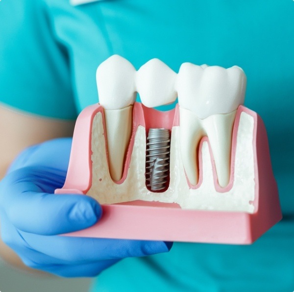 Model of dental implant supported replacement tooth