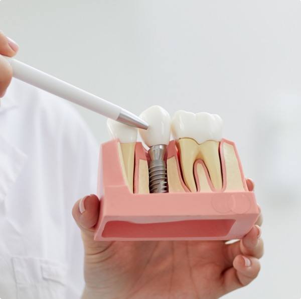 Dentist pointing to a dental implant model