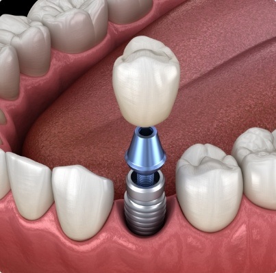 Animated smile during dental implant supported dental crown placement