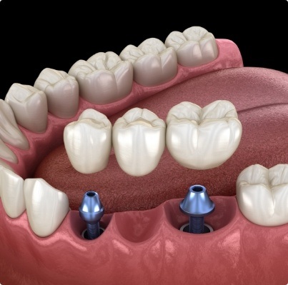 Animated smile during dental implant supported fixed bridge