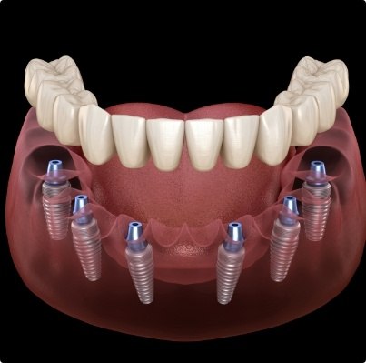 Animated smile during dental implant supported denture placement