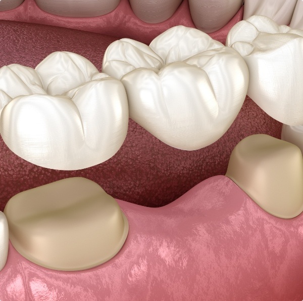 Animated smile during dental bridge placement