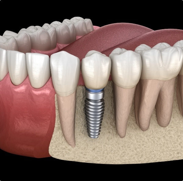 Animated smile with dental implant supported dental crown