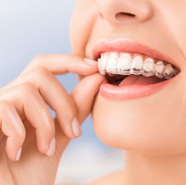 Closeup of dental patient placing an Invisalign tray