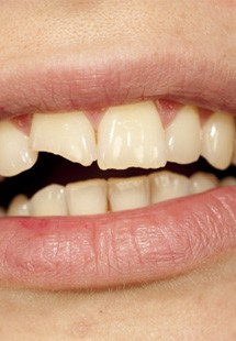 Closeup of a broken tooth