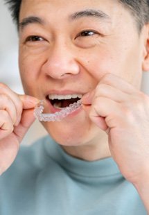 Man putting in clear aligners