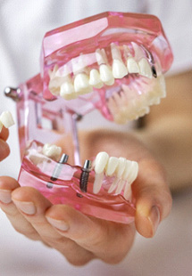 Hands holding sample jaw with two implants and model dental bridge
