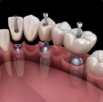 Animated smile during dental implant tooth replacement process