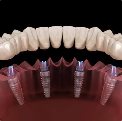 Animated smile during dental implant supported denture placement