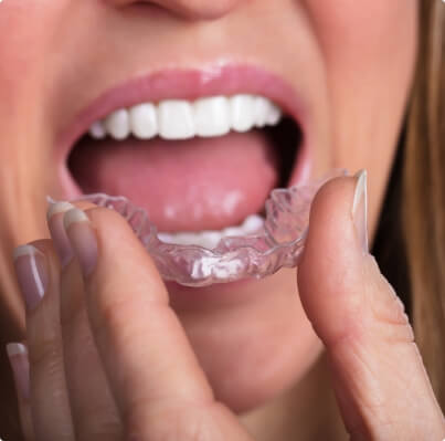 Closeup of dental patient placing a mouthguard